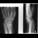 Fracture of distal metaepiphysis of the radius (Colles fracture): X-ray - Plain radiograph